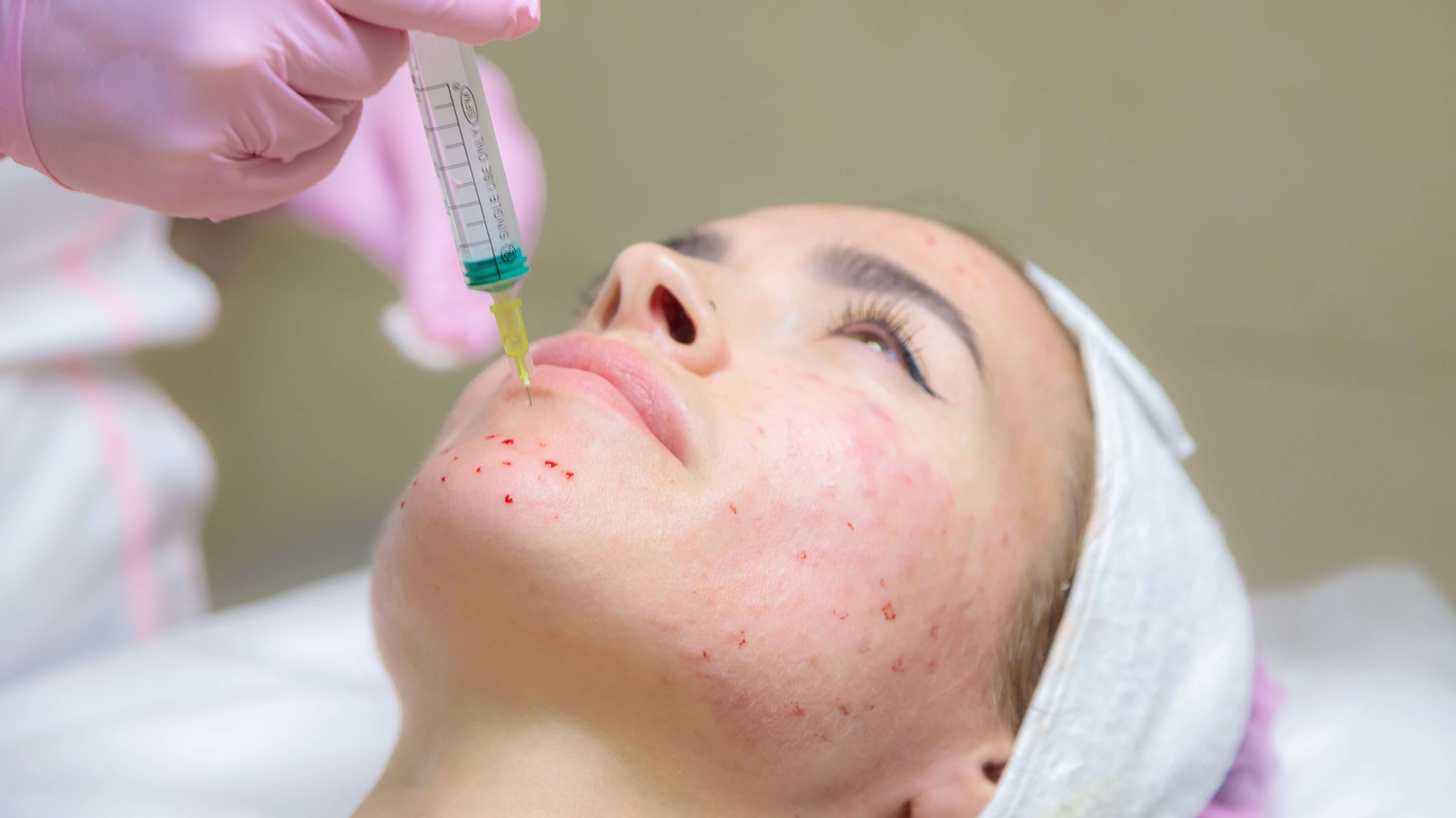 Understanding Acne Types & Effective Treatments