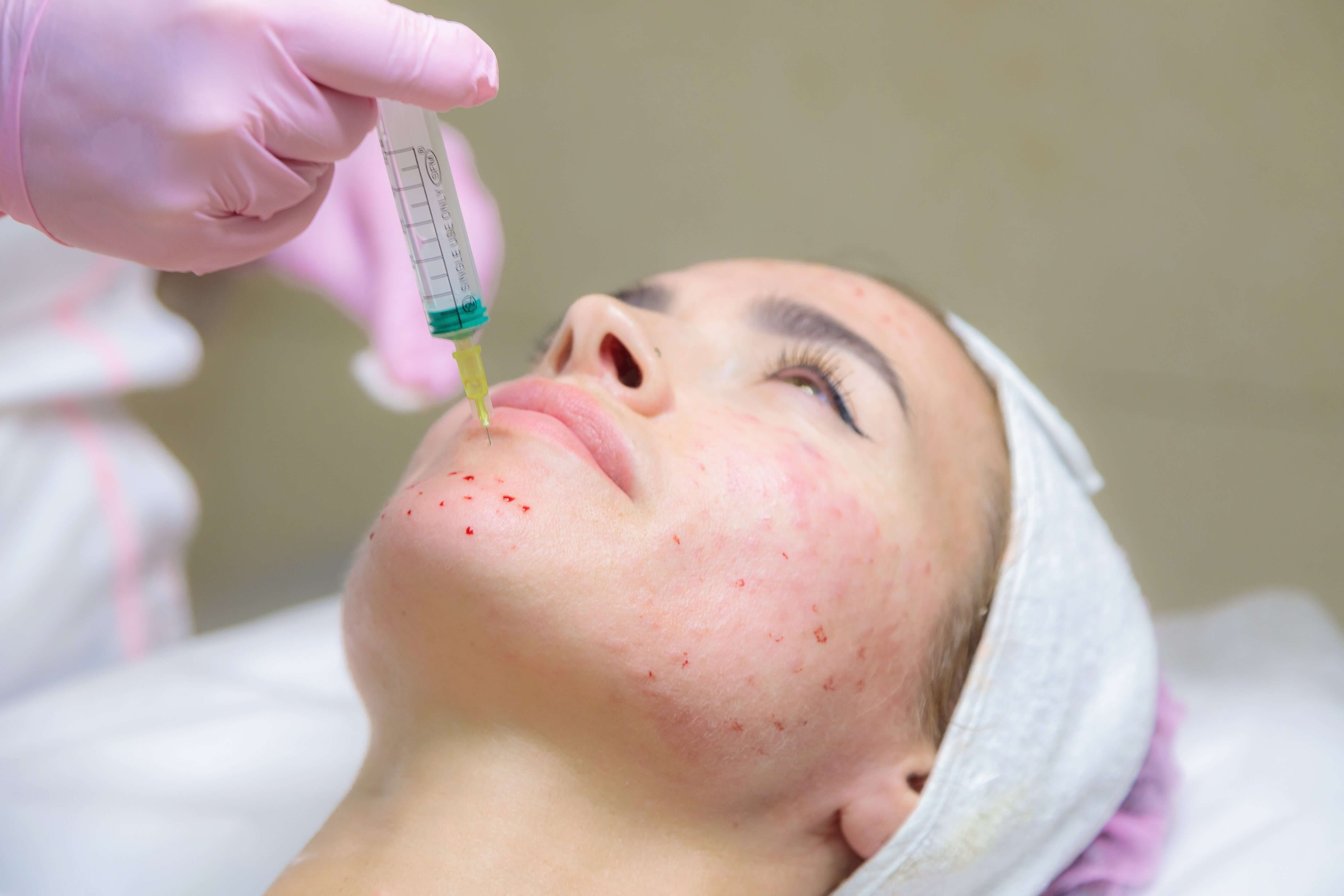 Understanding Acne Types & Effective Treatments