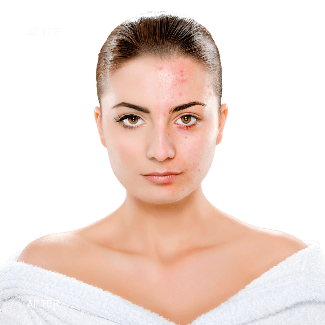 Woman's skin after using Beauty Wavez 72 Pimple Patchez showing reduced acne and clearer complexion.